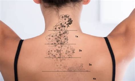 How Should I Care For My Skin After Laser Tattoo Removal | Yaletown Laser Centre