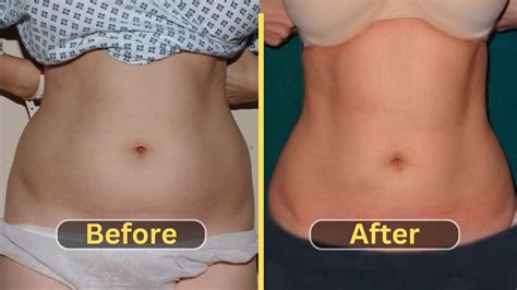 Lipo 360 Before and After Transformations: Get a Dream Body with - Weight Loss