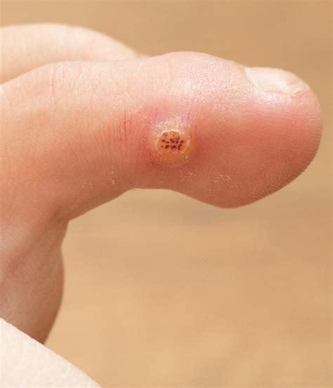 Warts & Removal | Mesa, AZ | Sagebrush Dermatology