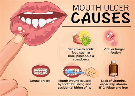 MOUTH SORES: EVERYTHING YOU NEED TO KNOW - Clinica Dental Tenerife Sur