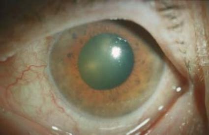Acute Angle Glaucoma Symptoms