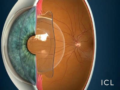 Implantable Contact Lens (ICL) surgery in Europe – Belgium | Betamedics