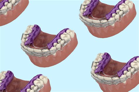 Inman Aligner For Fast Teeth Straightening - NuDental