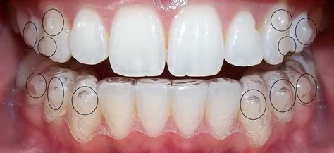 My Invisalign Journey (5): Attachments and Quick Update | Ortodoncia, Invisalign, Ortodoncia ...