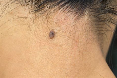 Melanoma on scalp pictures: early stage 1, scalp melanoma images, melanoma on neck pictures ...