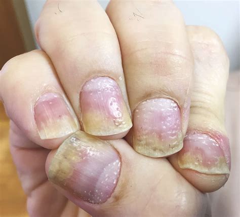 Pitted Nails as Sign of Psoriasis