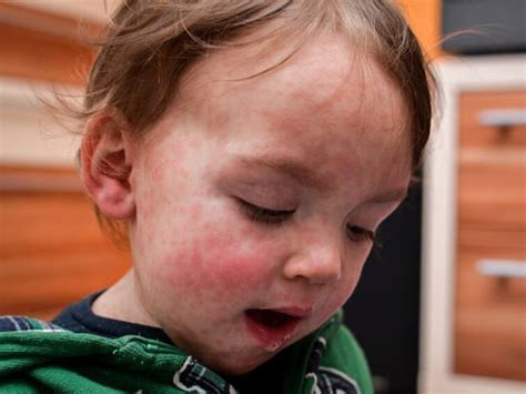 Measles Outbreak: All That You Need To Know About The Contagious Disease