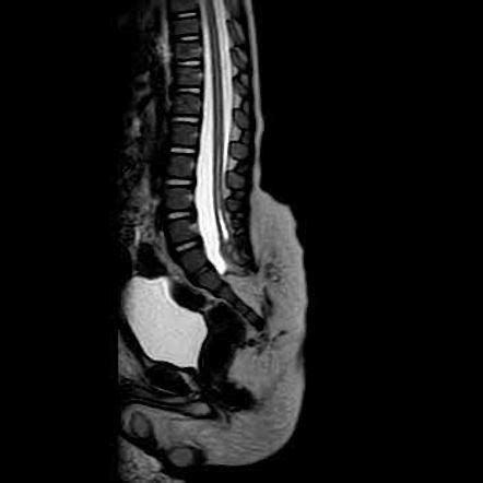 Tethered cord syndrome | Radiology Reference Article | Radiopaedia.org