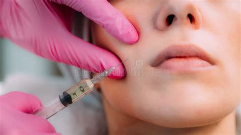 Dermal Filler Injection for Cheeks Stock Image - Image of doctor, dermatology: 221041283