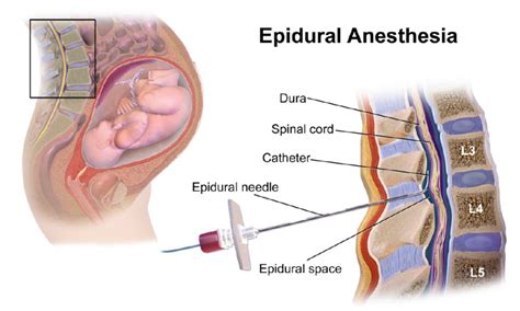 Anestesia epidural. Beneficios y contraindicaciones