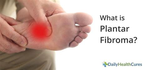 What is Plantar Fibroma and How is it Treated? | Daily health tips, Health, Health and fitness ...