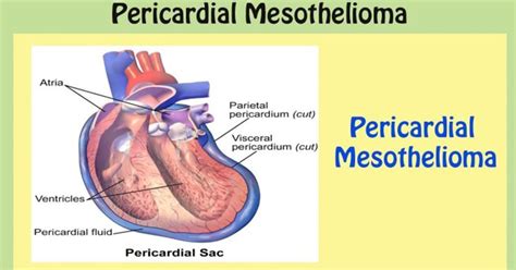 Pericardial Mesothelioma | Mesothelioma Affecting the Heart ...