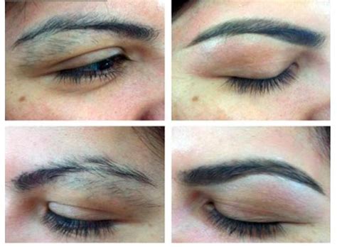 Eyebrow laser hair removal - Houston, TX | Hair Removal Treatment