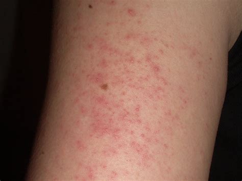 White Spot On Rash Arms at Gladys Martinez blog