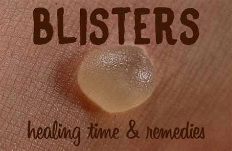 Blister Healing Time: How Long Does it Take for a Blister to Heal?