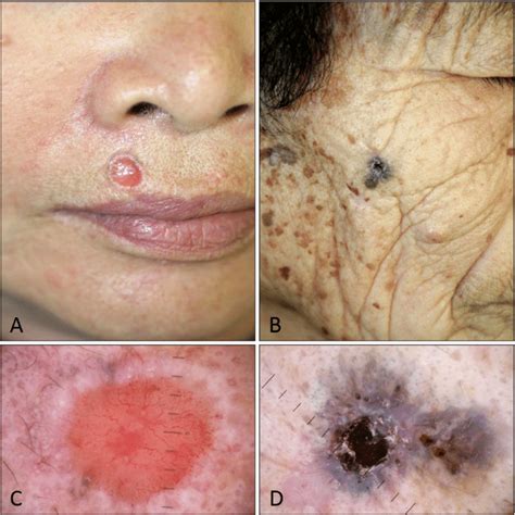 Skin Cancer Squamous Cell Carcinoma Symptoms - vrogue.co