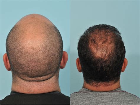 Hair Transplant Before & After #3 - Jesse E Smith, MD, FACS – Ft Worth ...