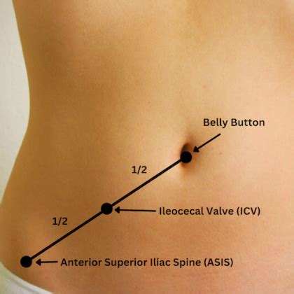 Ileocecal Valve Dysfunction | Acupuncture West London