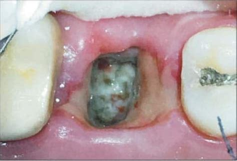 What is Dry Socket & When Can I Stop Worrying After a Tooth Extraction