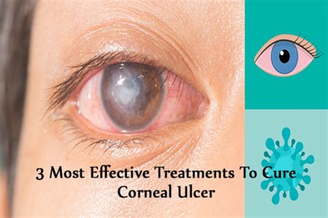 Diagnosis and Treatment of Corneal Ulcers | OBN