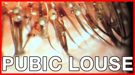 Crabs or Pubic Louse: Early Symptoms, Cure, Risks, Pictures - YouTube