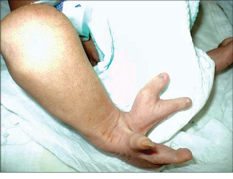 Figure 1 from A Case of Ectrodactyly in a Neonate | Semantic Scholar