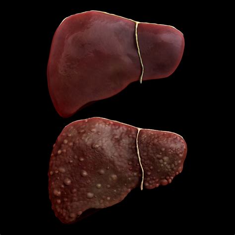 Tim Vernon - Healthy Liver Compared to Cirrhotic Liver