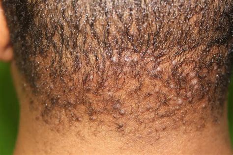 Acne Bumps On Back Of Head | SexiezPicz Web Porn