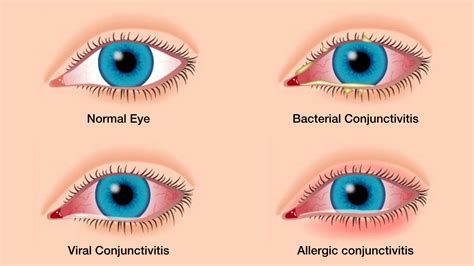 Conjunctivitis a.k.a Pink Eyes - A Beginner’s Guide!