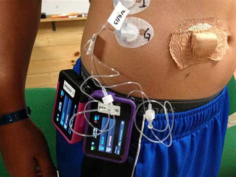 Endo Apps: The DIY Artificial Pancreas | MedPage Today