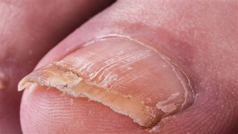 Onychomycosis: when the fungus is on the nails | Bullfrag