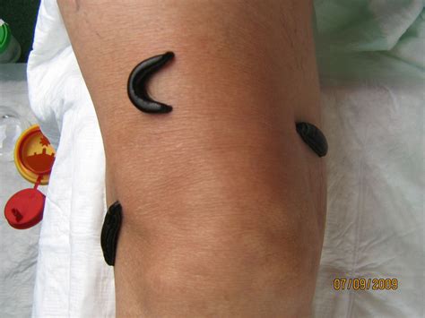 Leeches on knee- alternative therapy for arthrosis - DocCheck