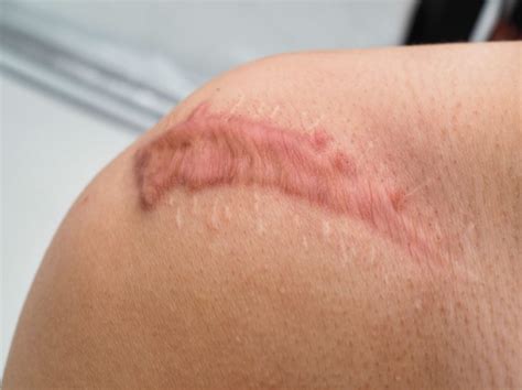 How To Diminish Post Surgical Scars - Sanara MedTech