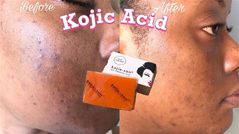 I USED KOJIC ACID SOAP FOR A MONTH | Honest Review, Tips, How to use 2022 | Trinidad YouTuber ...