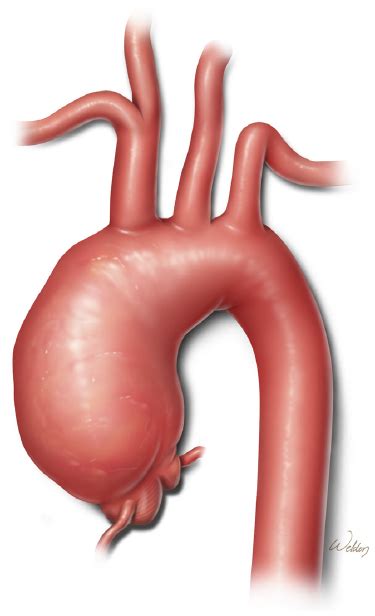 ascending aortic aneurysm | . This aneurysm involves the ascending aorta and transverse aortic ...