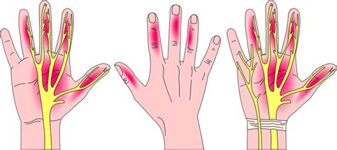 Seven Ways to Prevent Carpal Tunnel Syndrome | Midland Health Testing Services