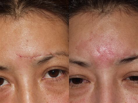 Before & After Pictures | Scar Revision Chicago, IL |Dr. Sidle