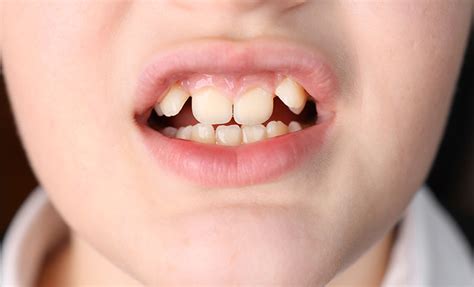 What Shark Teeth Means for a Child's Oral Health | Kenmore, WA ...