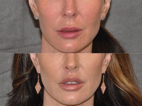 The Lip Lift is a cosmetic surgery that enhances the look of the entire ...