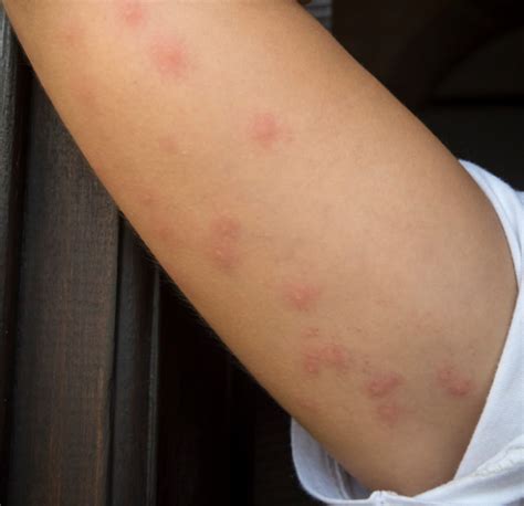 Bed Bug Bites Pictures, Symptoms: What Do Bed Bug Bites Look Like ...