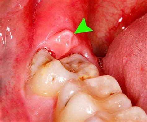 Swollen Gums: Causes, Treatment, and Prevention - Healthrow.net