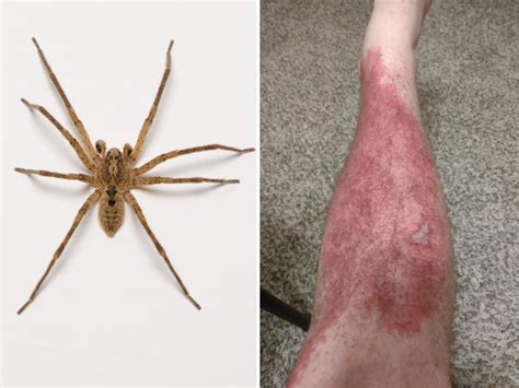 Man Bitten by Spider As He Slept Left in "Immense" Pain, Covered in Rash