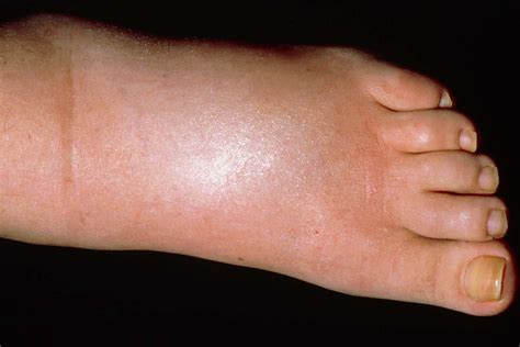 Swollen ankles, feet and legs (oedema) - EM Doctors