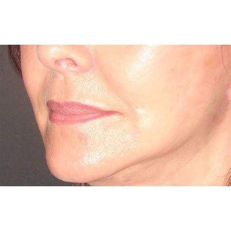 Lip Lift Mission Viejo, CA | Orange County Surgical Specialists