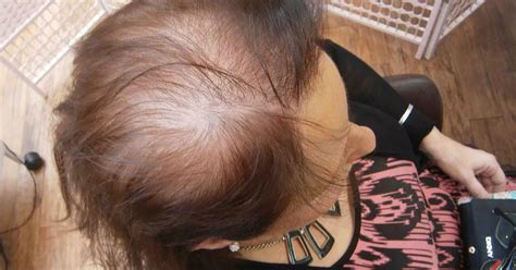 Thinning locks and bald patches... the hidden horrors of female hair ...