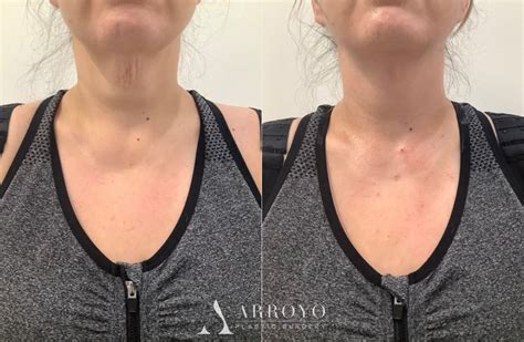 Thread Lift Before & After Photos | Arroyo Plastic Surgery