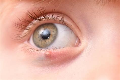 Tips for Recognizing a Stye (and What to Do About It): Penguin Pediatrics PLLC: Pediatric Care