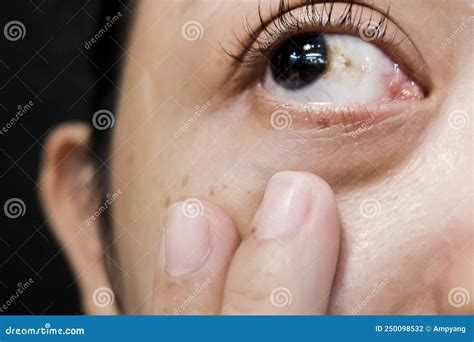 Eye. Conjunctiva And Sclera Stock Image | CartoonDealer.com #220382497