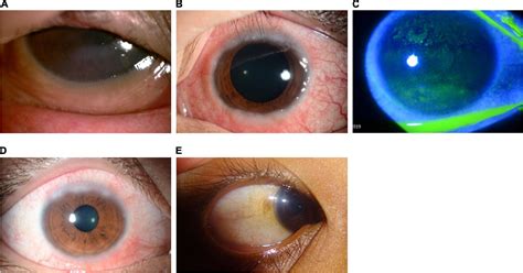 Frontiers | Diagnosis, Management, and Treatment of Vernal Keratoconjunctivitis in Asia ...