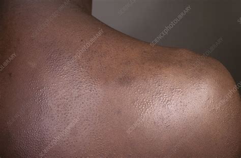 Follicular mucinosis - Stock Image - C040/2256 - Science Photo Library